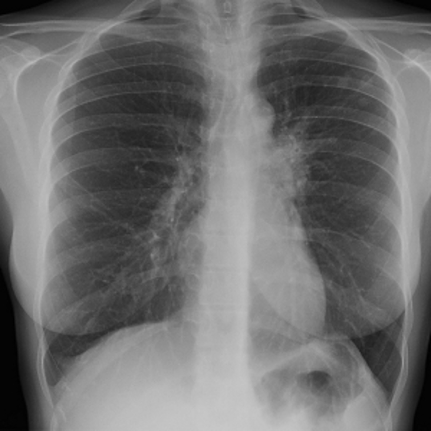 tuberculosis a disease making a comeback essay tuberculosis a disease making a comeback essay