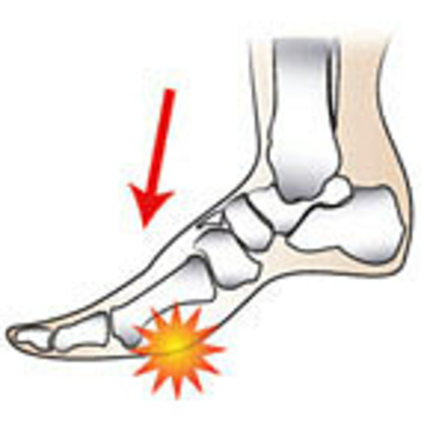 Episode 92: Ep92 - Forefoot pain