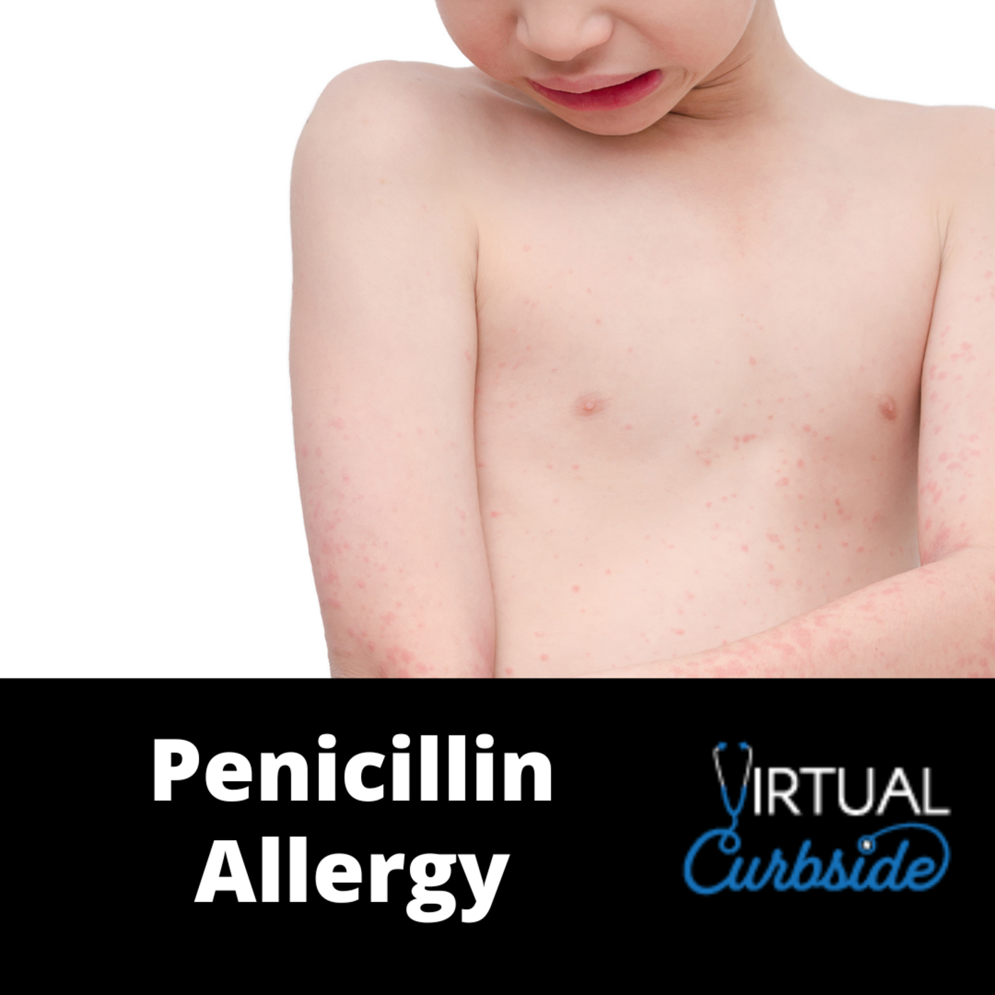 Episode 194: #45-3 Penicillin Allergy Treatment