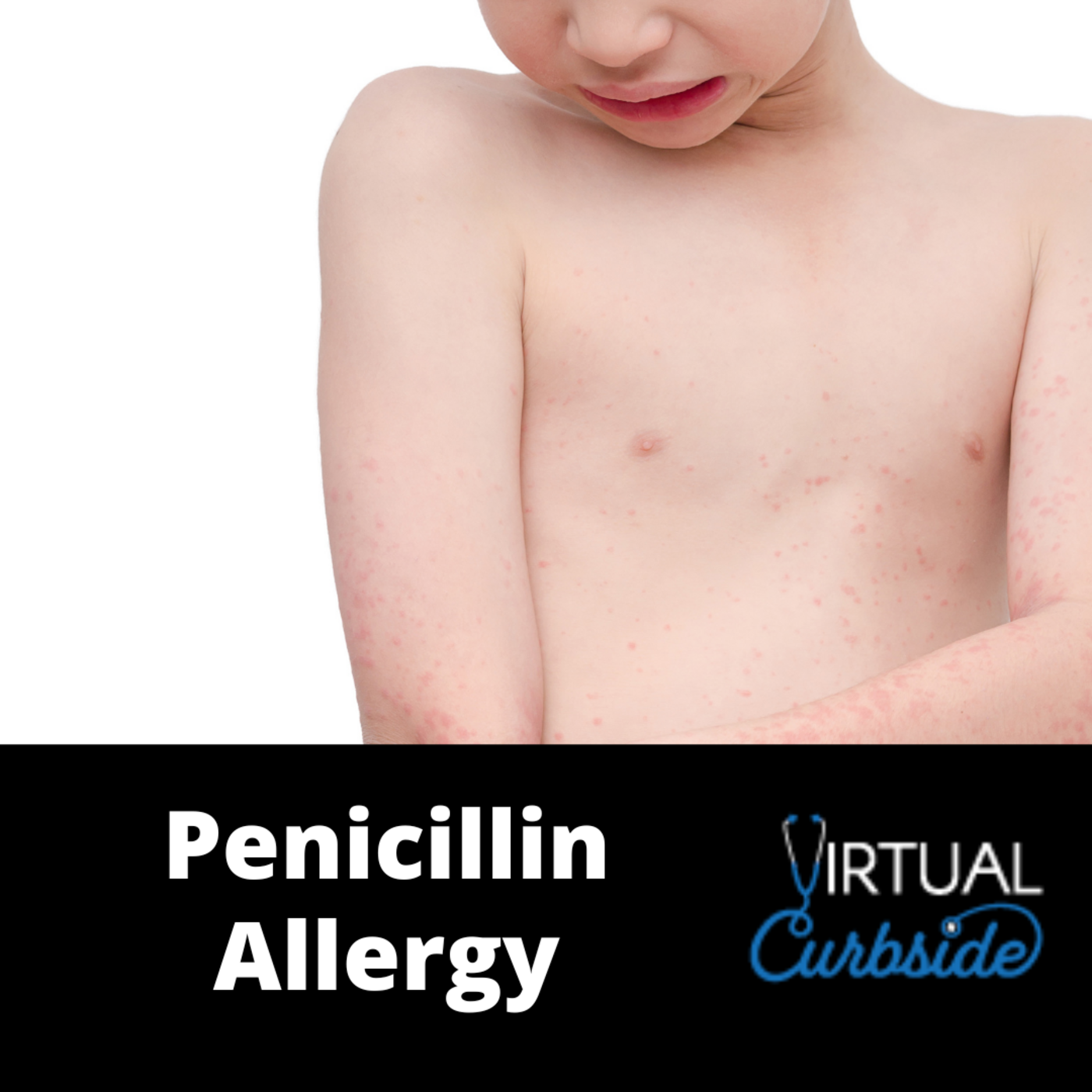 Episode 195: #45-4 Q & A Penicillin Allergy