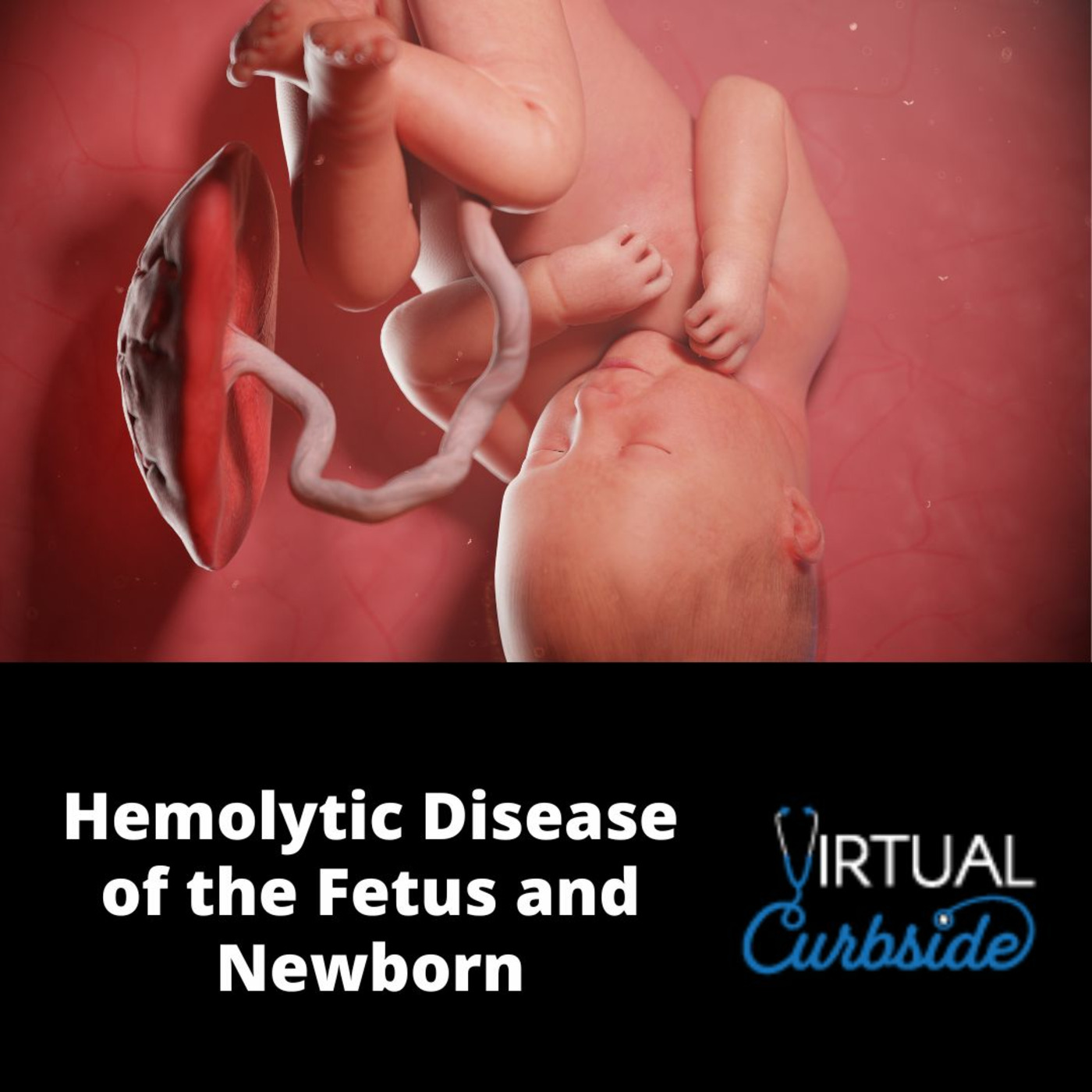Episode 362: #84-3 Hemolytic Disease of the Fetus and Newborn: Management