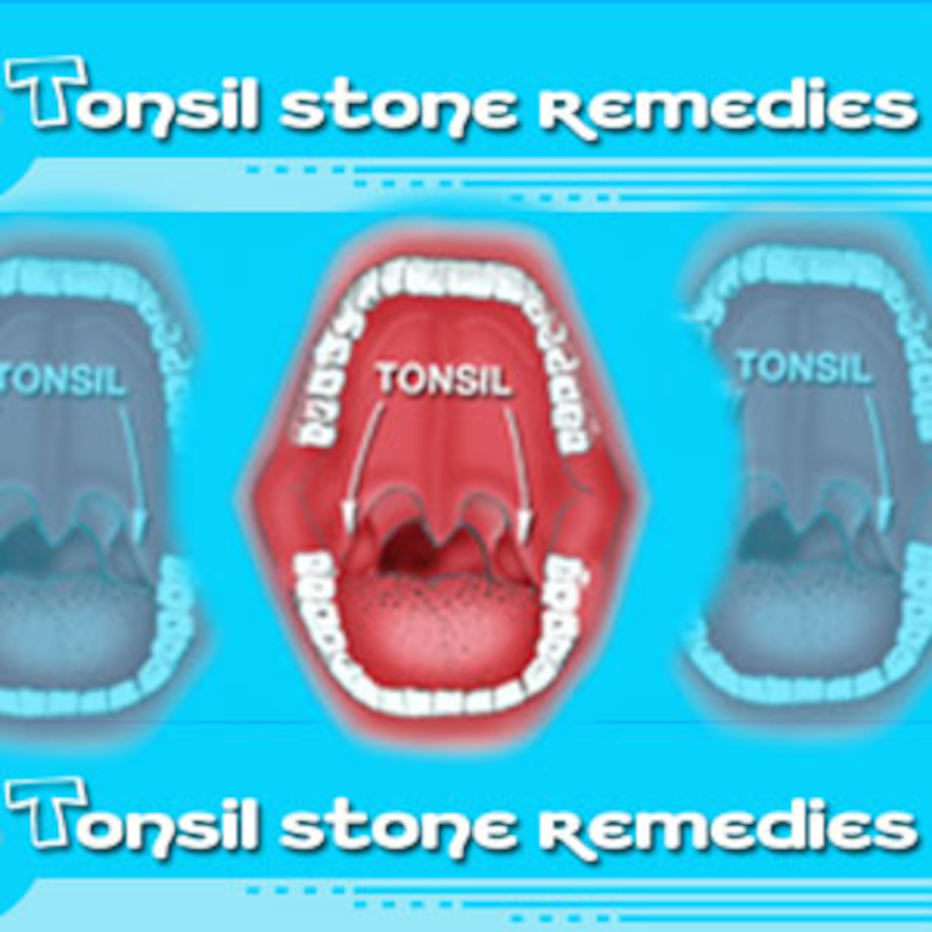 Laser Tonsillectomy a Permanent Cure for Tonsil Stones