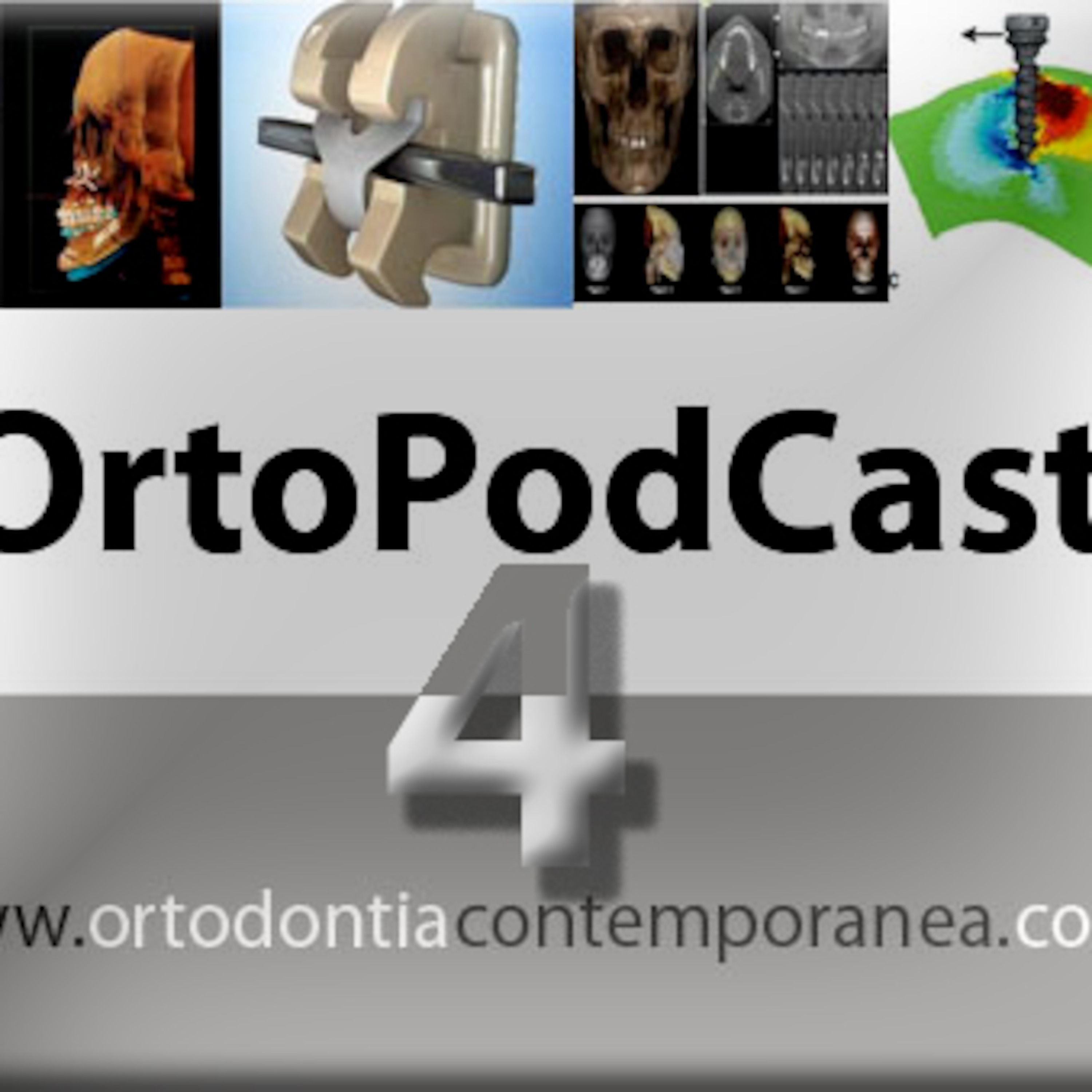 Episode 4 - Distrator ósseo Implanto-dento suportado