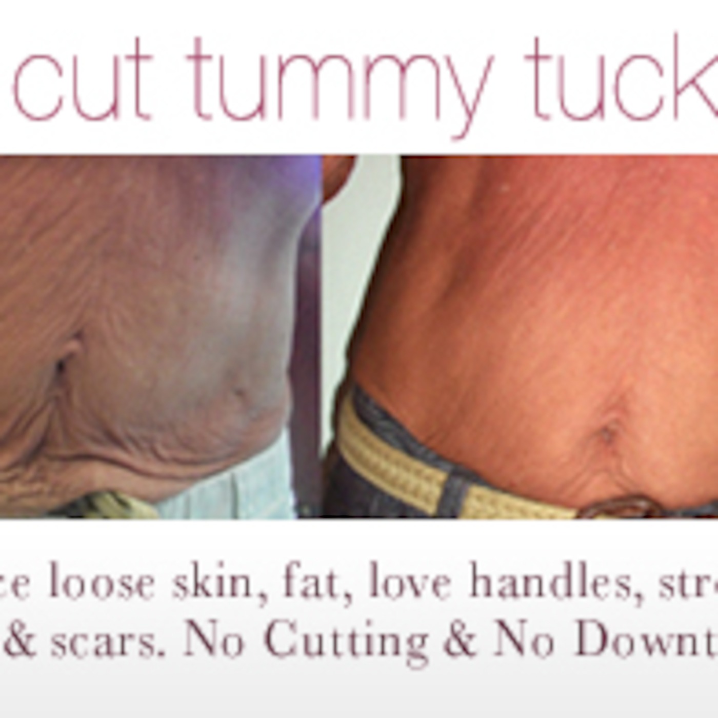 Balancing Body Talk: Angel Lift Body Contouring