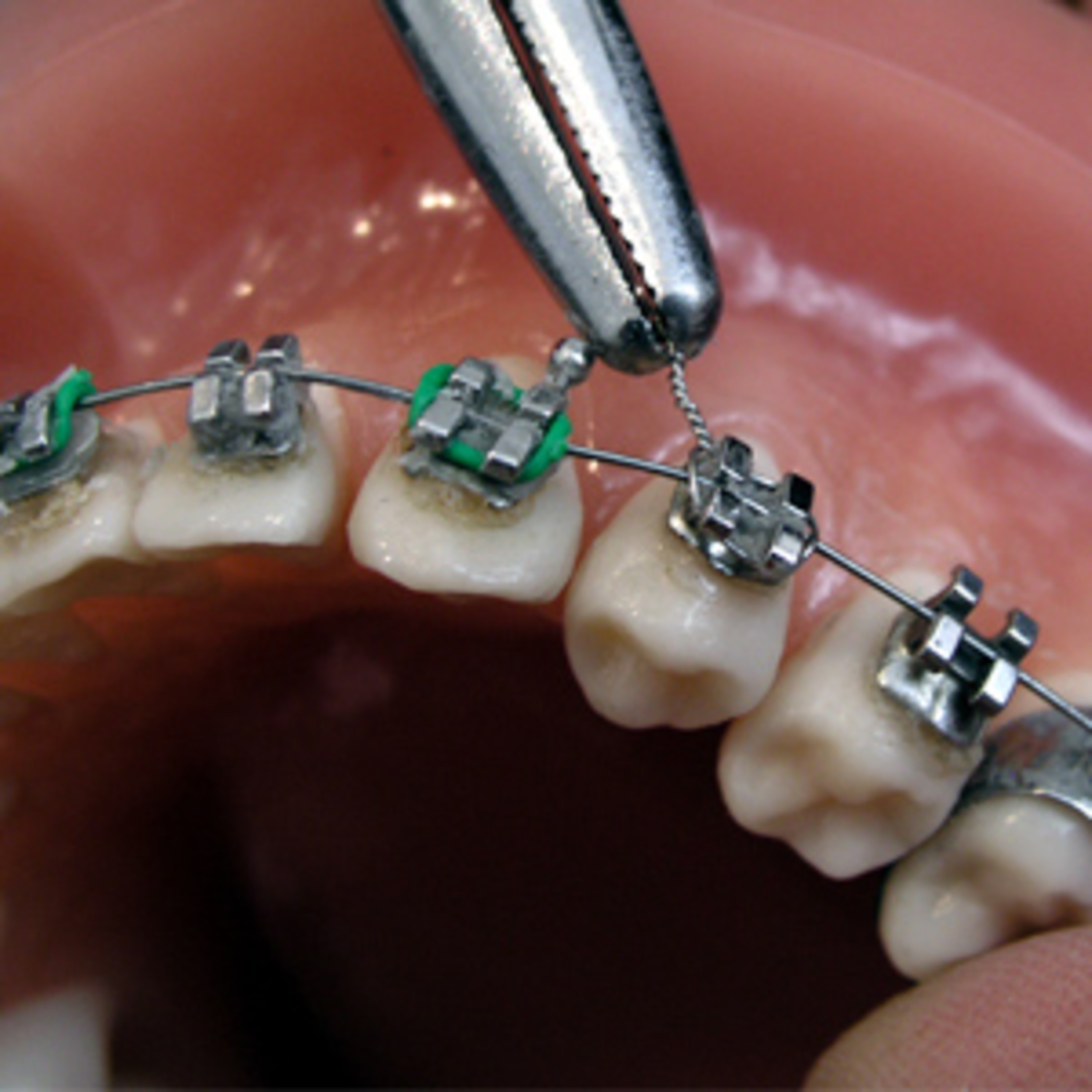 Maintain your oral care throughout orthodontic treatment episode artwork