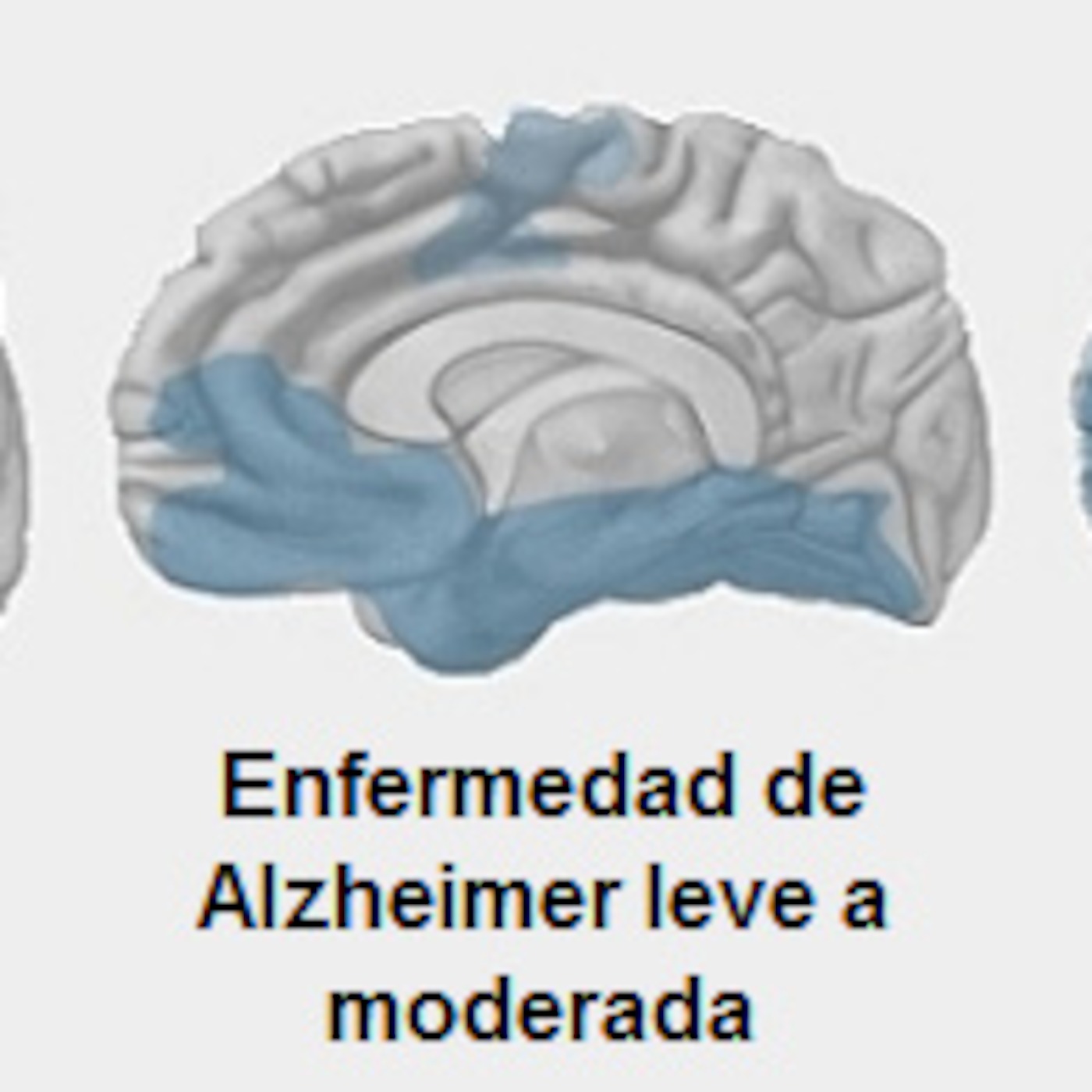 ¿En qué fase del Alzheimer está mi familiar? episode artwork
