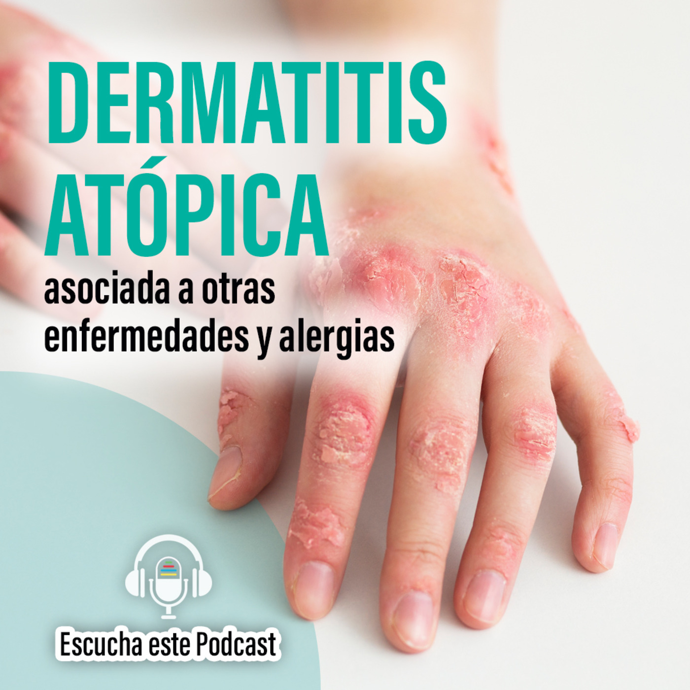 Dermatitis atópica asociada a otras enfermedades y alergias. episode artwork