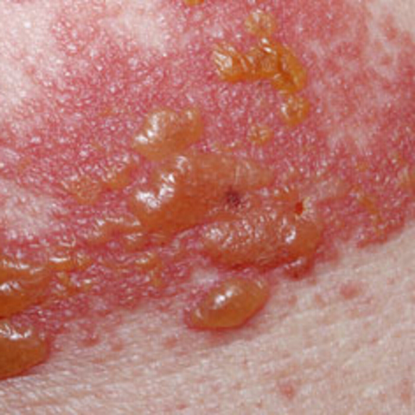 Shingles Vaccine episode artwork