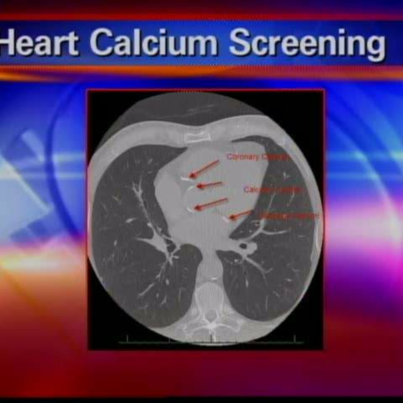 Hearts and Calcium Scores episode artwork